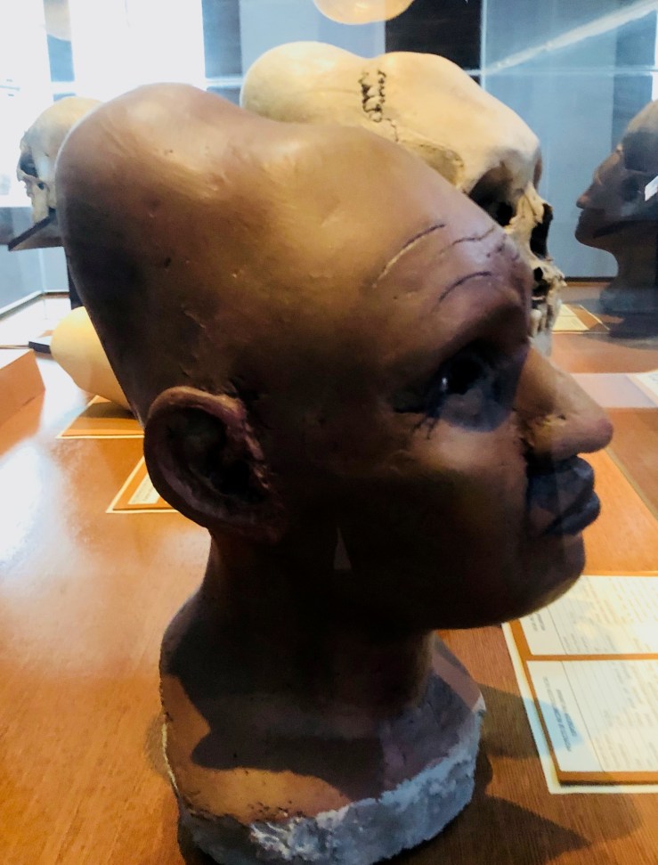 Crane déformé - Musée Anthropologique - Sucre - Bolivie